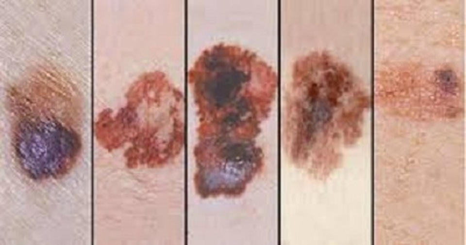 Phát triển miếng dán điều trị ung thư da - 1 Phát triển miếng dán điều trị ung thư da - 1