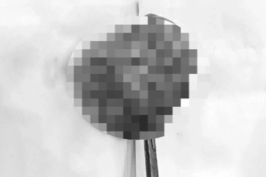 Khối nhân xơ to như quả cam "mọc" trong tử cung người phụ nữ