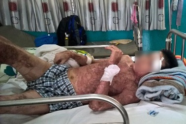 Bệnh nhân bỏng nặng vì dùng xăng nhóm lửa