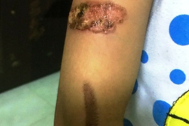 Vụ bé gái nghi bị dí sắt nung: Mẹ ruột kiện đòi quyền nuôi con