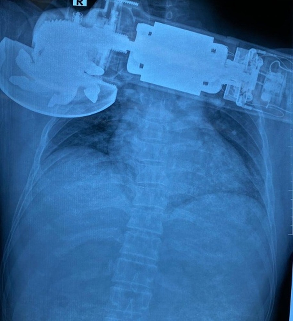 Vào viện cấp cứu, người đàn ông ôm theo máy chà cắm găm vào ngực - 1 Vào viện cấp cứu, người đàn ông ôm theo máy chà cắm găm vào ngực - 1