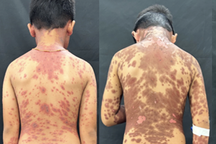 Bé trai 10 tuổi biến dạng da toàn thân nặng nề sau khi uống thuốc động kinh