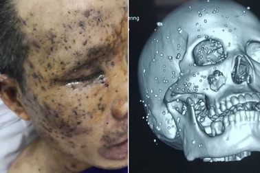 Hy hữu ca tai nạn bị hơn 100 mảnh nhọn găm chi chít trên mặt