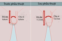 “Trình làng” kỹ thuật tăng kích thước “cậu nhỏ” đơn giản đến ngạc nhiên