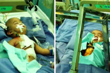 Một bé trong ca tách song sinh Long - Phụng đã ra đi