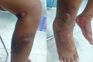 Giám định thương tật đối với bé trai bị bỏng rộp nghi do bạo hành ở TPHCM