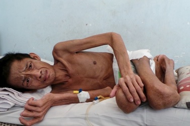 Cảnh "sống không bằng chết" của người đàn ông gặp tai nạn lao động thương tâm