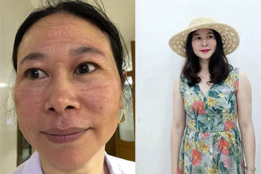 Khuôn mặt hằn vết đồ bảo hộ của nữ bác sĩ chống dịch Covid-19