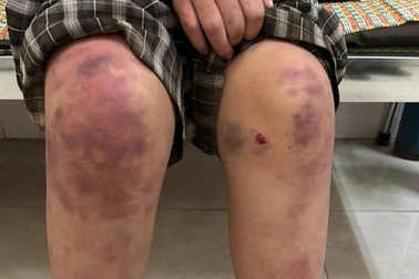 Bé gái 12 tuổi nghi bị bà nội hành hạ, may mắn không gãy xương