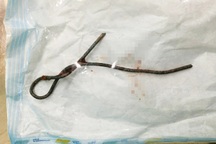 Làm theo phim, bé trai 6 tuổi nhét thanh sắt dài nửa mét xuyên sâu hậu môn