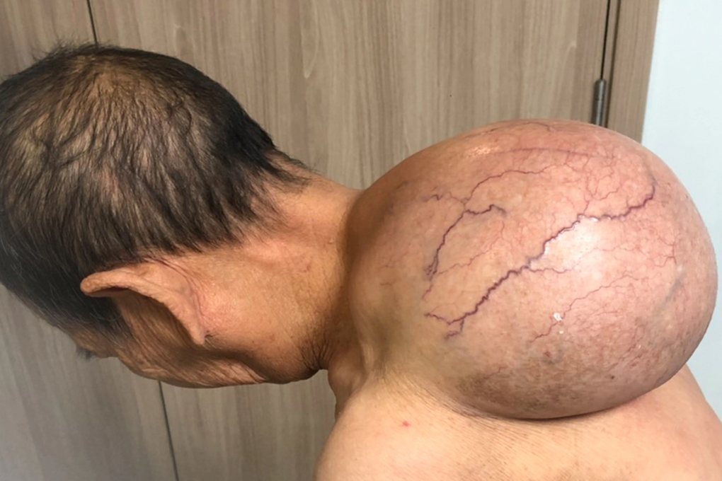 Cụ bà được giải thoát khỏi khối u 5kg mọc trên lưng - 1 Cụ bà được giải thoát khỏi khối u 5kg mọc trên lưng - 1