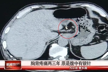 Bị kim châm cứu mắc kẹt trong ruột suốt 40 năm