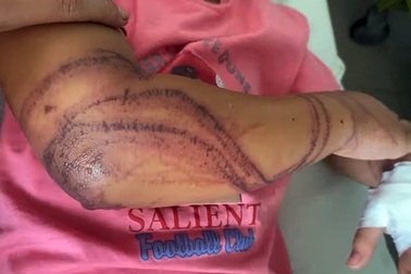 Tắm biển ở Nha Trang, bé gái 7 tuổi bị sứa đốt đến bất tỉnh