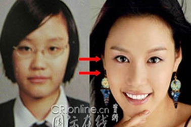 Người đẹp Hàn Quốc đẹp lên nhờ… dao kéo?