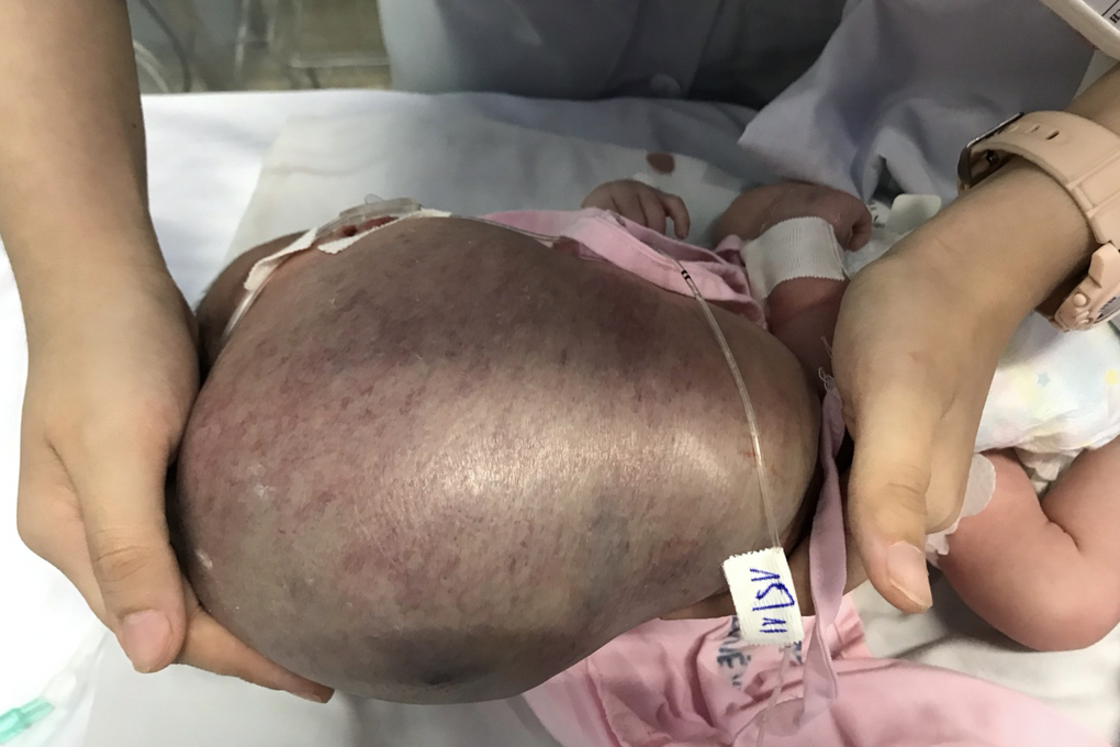 Bé trai mới sinh ở TPHCM đã mang miệng ếch khổng lồ, đầu lệch sang trái - 2