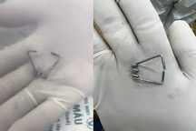 Bé trai ở TPHCM nuốt lò xo sắt chặn ngang cổ họng