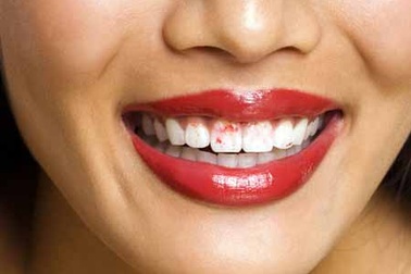 Điều trị chứng khô miệng