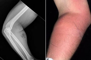 Người đàn ông tự tiêm… tinh trùng để chữa đau lưng