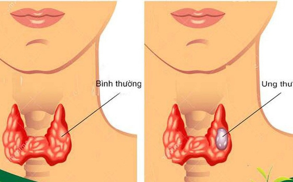 Ung thư tuyến giáp: Ăn gì sau khi uống iod phóng xạ? - 2 Ung thư tuyến giáp: Ăn gì sau khi uống iod phóng xạ? - 2