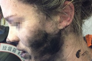 Apple “phủi trách nhiệm” vụ nổ tai nghe khiến người dùng bỏng mặt