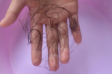 Rụng tóc: Bệnh không nguy hiểm nhưng khó chữa