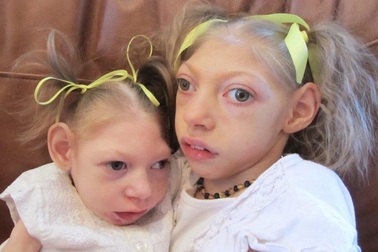 WHO khẳng định Zika gây các bệnh liên quan đến thần kinh