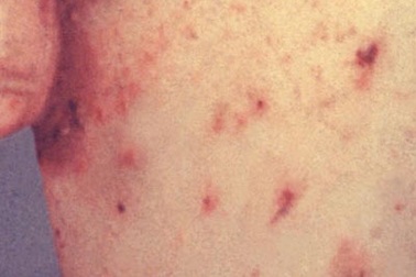 Bệnh ghẻ… lan rộng