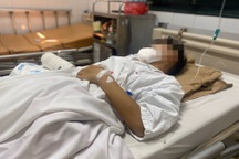 Nghịch pháo, nam sinh 15 tuổi bị cắt cụt tay phải