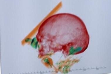 Phát hiện hài cốt người trong hành lý xách tay