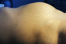 Cảnh báo nhiều phụ nữ bị u xơ tử cung lâm nguy vì không điều trị sớm