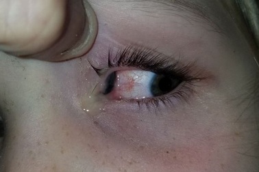 Bọ lớn chui vào tuyến lệ của bé gái 6 tuổi