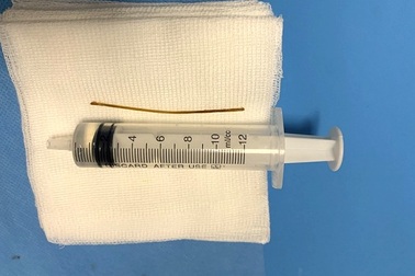 Tăm tre xuyên qua ruột non, găm vào thành bụng người đàn ông ở Hà Nội