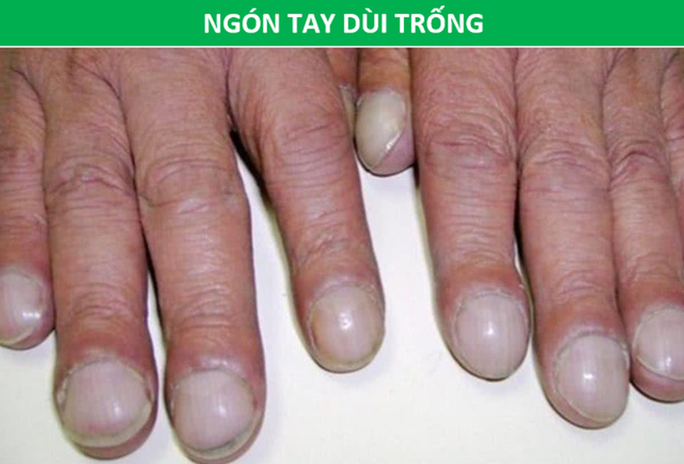 Cảnh giác với những dấu hiệu dễ bị nhầm lẫn của ung thư phổi - 3 Cảnh giác với những dấu hiệu dễ bị nhầm lẫn của ung thư phổi - 3