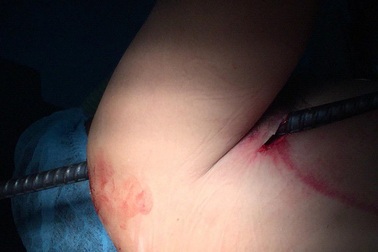 Bệnh nhân nhập viện cùng cây sắt xuyên thấu vai nách