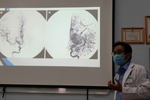 Bé 5 tuổi nhiều lần đột quỵ vì "làn khói" trong não