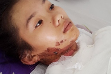 Nữ sinh lớp 10 nguy kịch vì bỏng nặng 