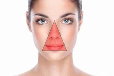 Tại sao không được nặn mụn ở vùng “tam giác chết”?