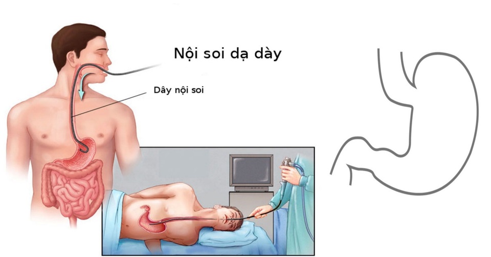 Phát hiện sớm ung thư dạ dày bằng cách nào? - 1 Phát hiện sớm ung thư dạ dày bằng cách nào? - 1