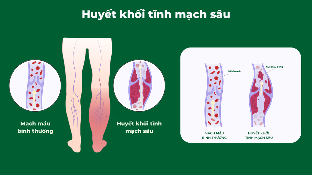 Điều trị suy giãn tĩnh mạch và những biến chứng tiềm ẩn cần biết - 5 Điều trị suy giãn tĩnh mạch và những biến chứng tiềm ẩn cần biết - 5
