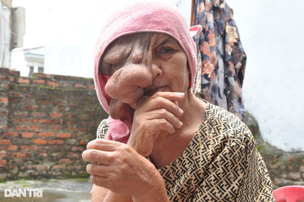 Người đàn bà có khối u khổng lồ bước đầu phẫu thuật thành công - 1 Người đàn bà có khối u khổng lồ bước đầu phẫu thuật thành công - 1