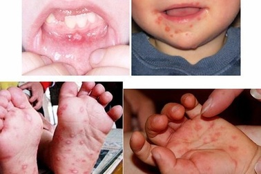 Bệnh tay chân miệng có mấy cấp độ? Cách điều trị như thế nào?