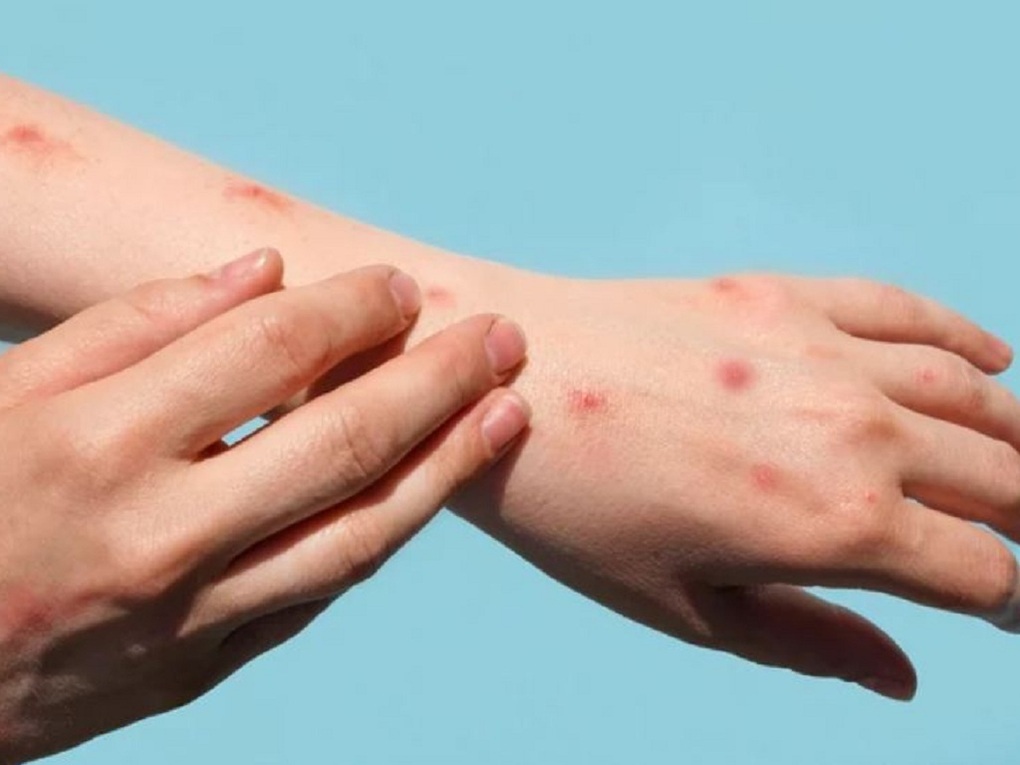 Các dấu hiệu nguy hiểm của bệnh đậu mùa khỉ - 2 Các dấu hiệu nguy hiểm của bệnh đậu mùa khỉ - 2