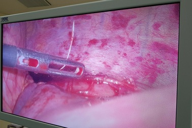 Hóc xương cá, nam bệnh nhân phải mổ lồng ngực lấy dị vật