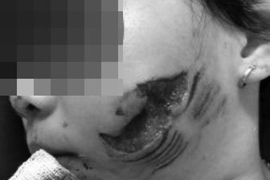 Liên tiếp 3 bệnh nhi bị chó nhà nổi điên cắn nát mặt