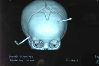 Bị thanh sắt đâm xuyên đầu, bé 10 tháng tuổi sống sót thần kỳ