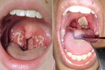 Bệnh bạch hầu: Tăng nguy cơ tử vong vì tắc đường thở, viêm cơ tim