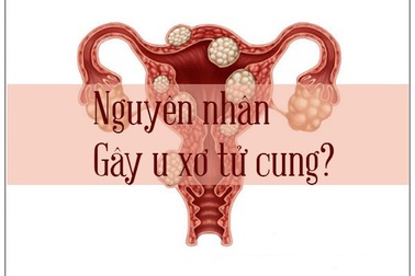 Nguyên nhân gây u xơ tử cung và cách phòng ngừa, cải thiện hiệu quả nhờ Nga Phụ Khang
