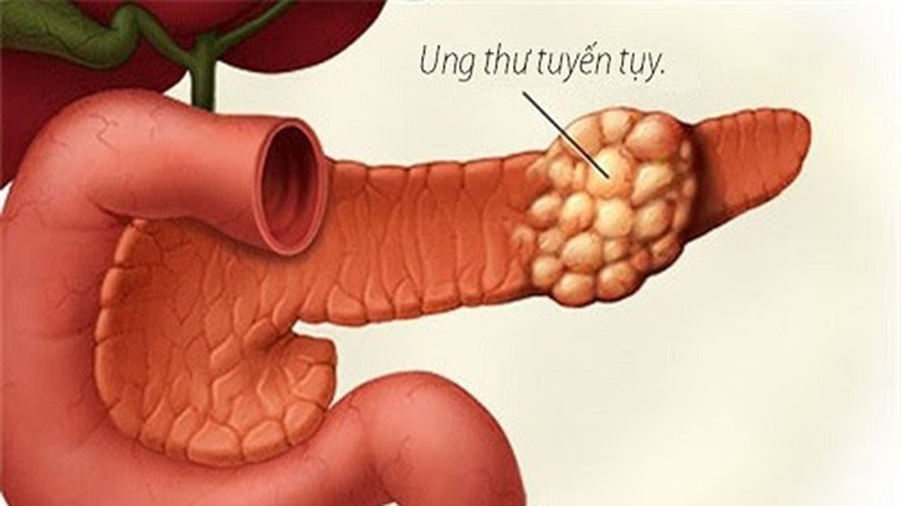 Các yếu tố làm gia tăng nguy cơ ung thư tụy - 1 Các yếu tố làm gia tăng nguy cơ ung thư tụy - 1