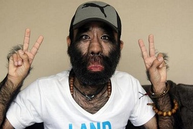 Người đàn ông “rậm rạp” nhất thế giới điều trị triệt lông