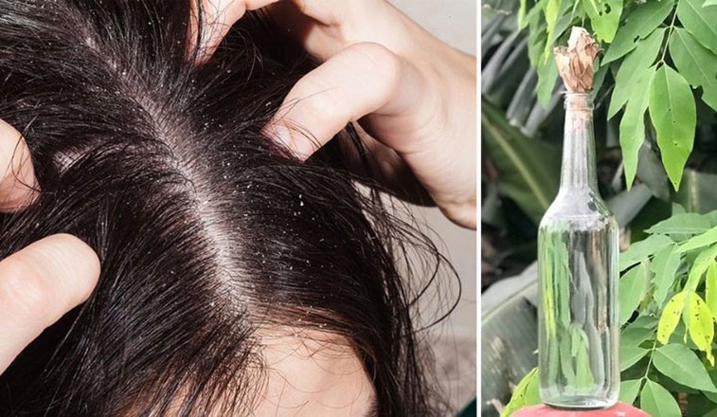 Hai mẹ con gặp họa vì dùng hạt na diệt chấy - 1 Hai mẹ con gặp họa vì dùng hạt na diệt chấy - 1